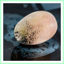 Calculous Cholecystitis Calculous Cholecystitis
