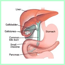 Cholelithiasis Cholelithiasis