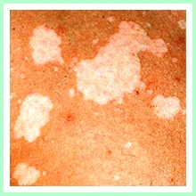 Chromophytosis Chromophytosis