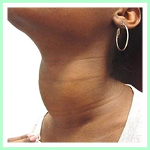 Diffuse toxic goiter Diffuse toxic goiter