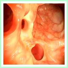 Diverticulosis Diverticulosis