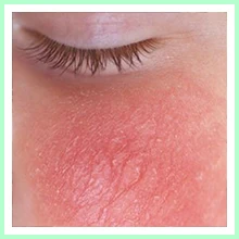 Eczema Eczema