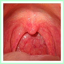 Pharyngitis Pharyngitis