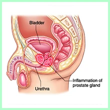 Prostatitis Prostatitis