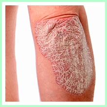 Psoriasis Psoriasis