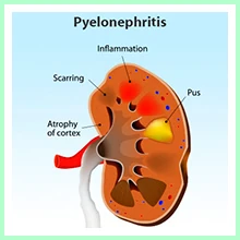 Pyelonephritis Pyelonephritis
