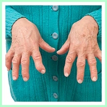 Rheumatoid arthritis Rheumatoid arthritis