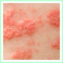Shingles Shingles