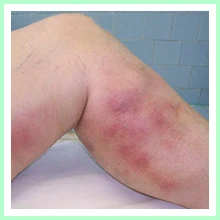 Thrombophlebitis Thrombophlebitis