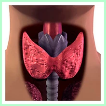 Thyroid dysfunction - Hyperthyroidism Thyroid dysfunction - Hyperthyroidism