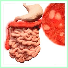 Ulcerative Colitis Ulcerative Colitis